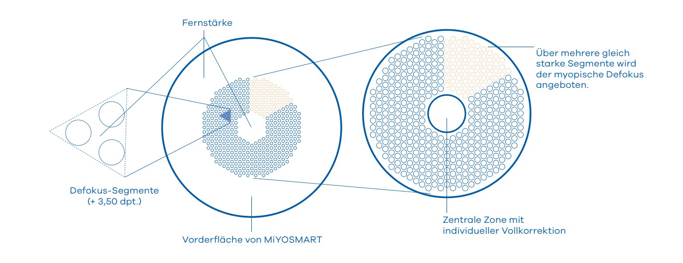 Miyopie Infografik