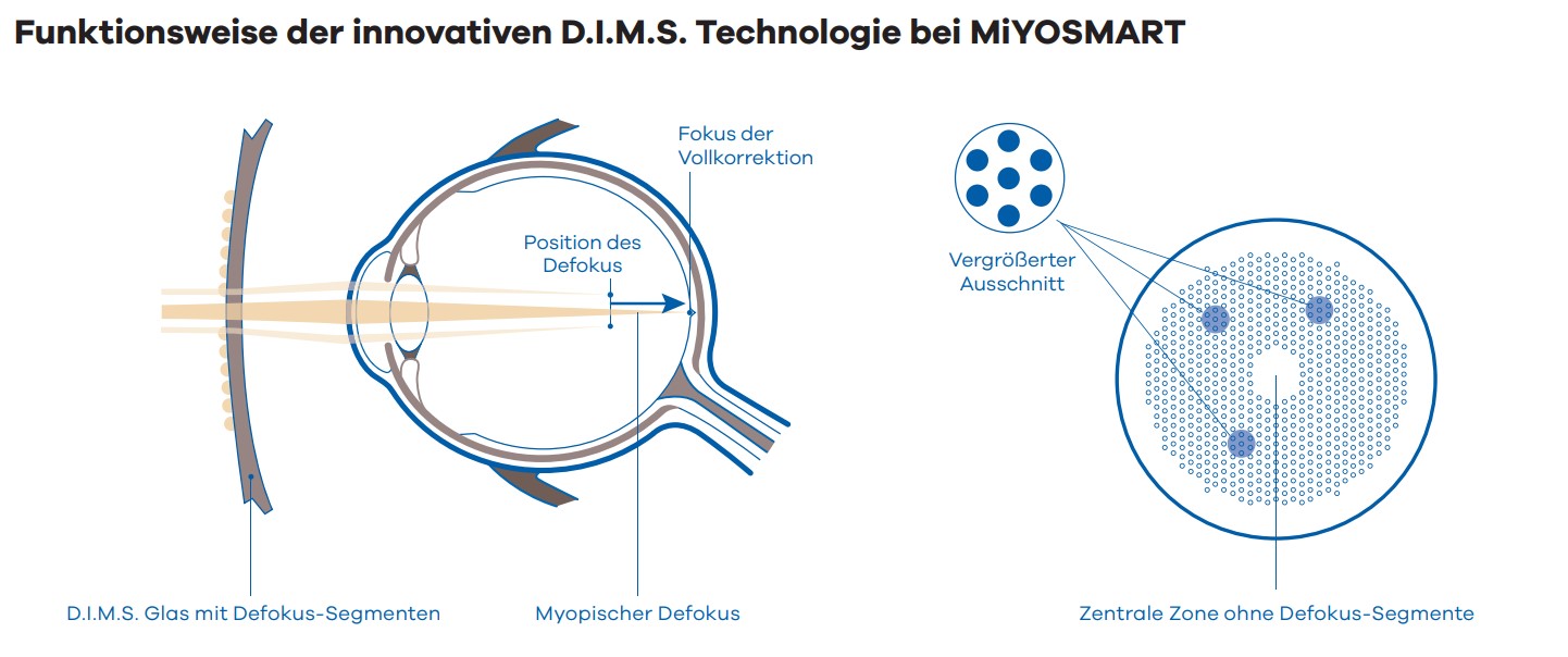 Miyopie Infografik